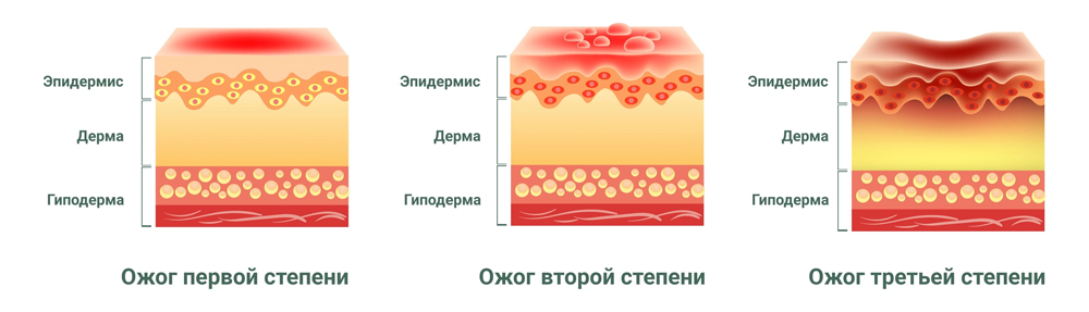 Препарат Эплан для лечения солнечного ожога